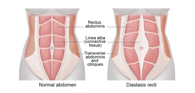 产后腹直肌分离的修复方法、腹部瘦身减肥方法