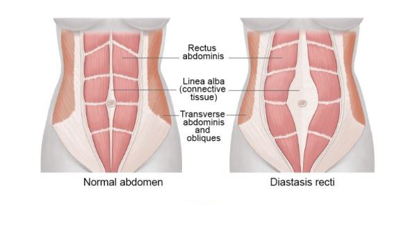 腹直肌分离的危害