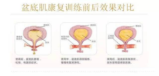 盆底康复治疗仪