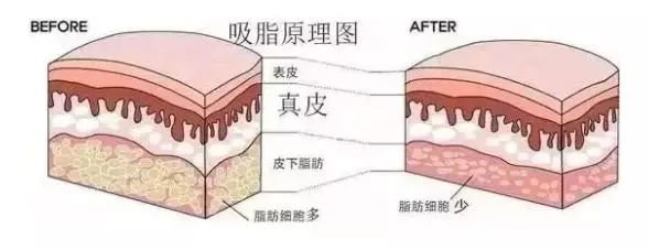 抽脂减肥瘦身