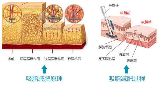 瘦身吸脂多少钱