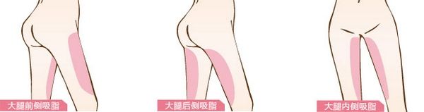 瘦身吸脂多少钱